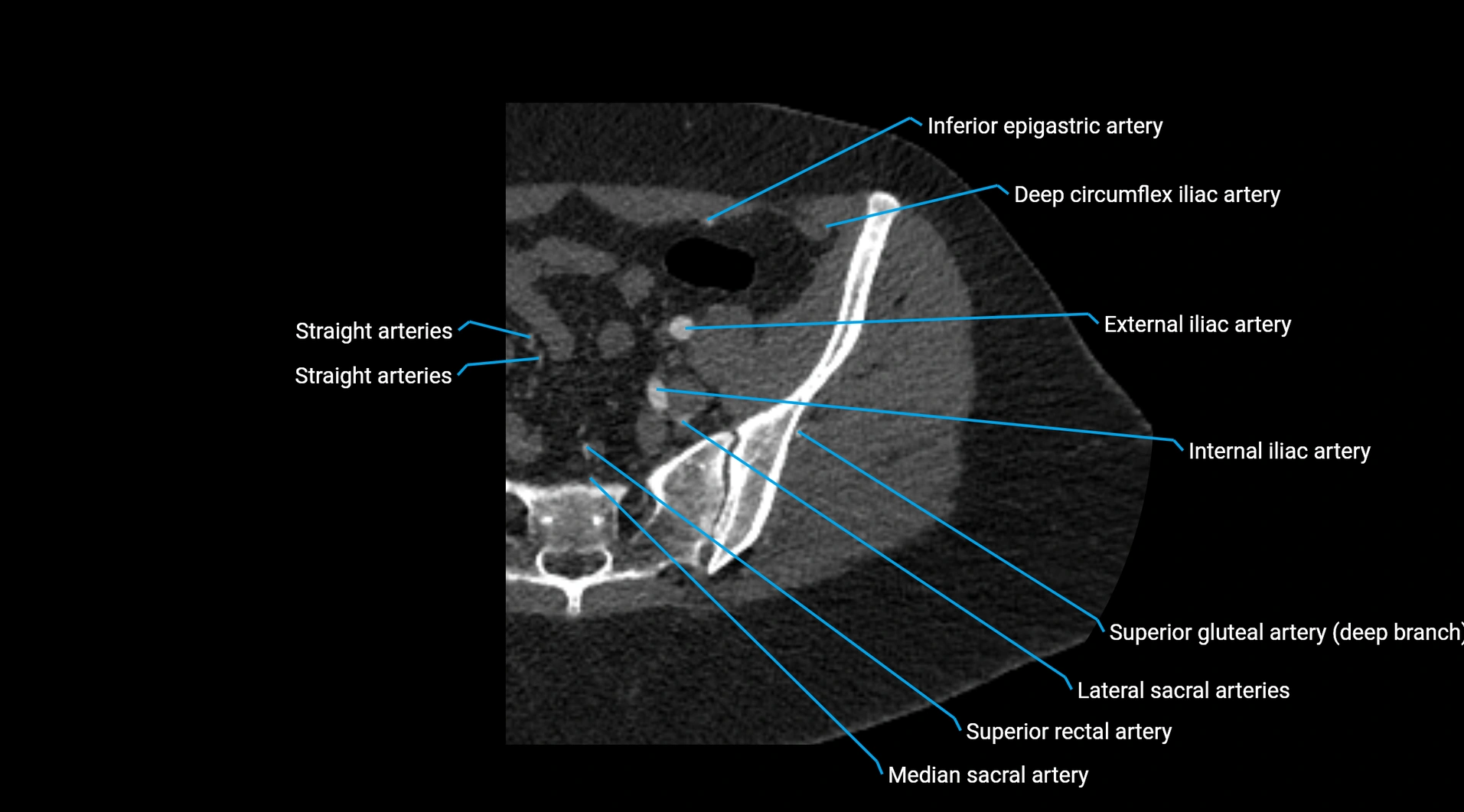 CTA lower limb cross sectional anatomy labelled image _27.webp